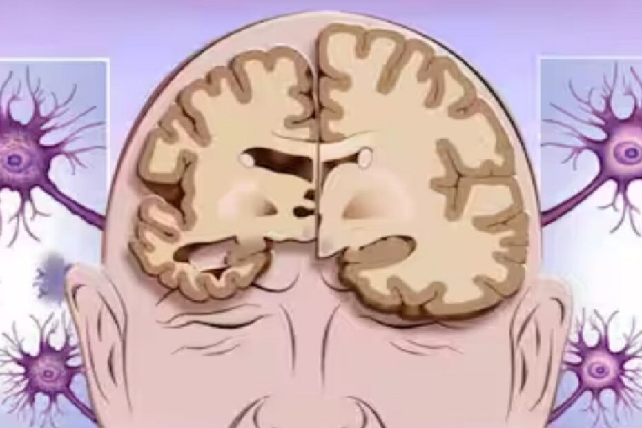 semnele distinctive ale bolii Alzheimer