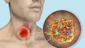 Simptome cancer tiroidian