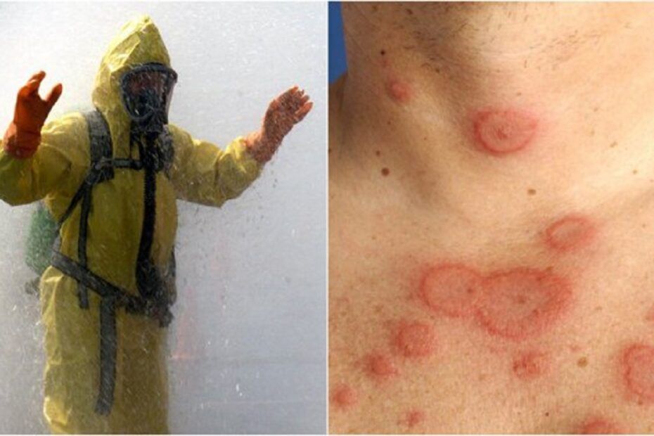 Două cazuri de difterie cutanată netoxigenă au fost confirmate în București, au declarat reprezentanţi ai INSP. A