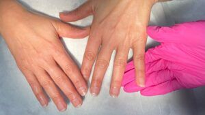 Top 3 terapii dermatologice pentru rejuvenarea mâinilor