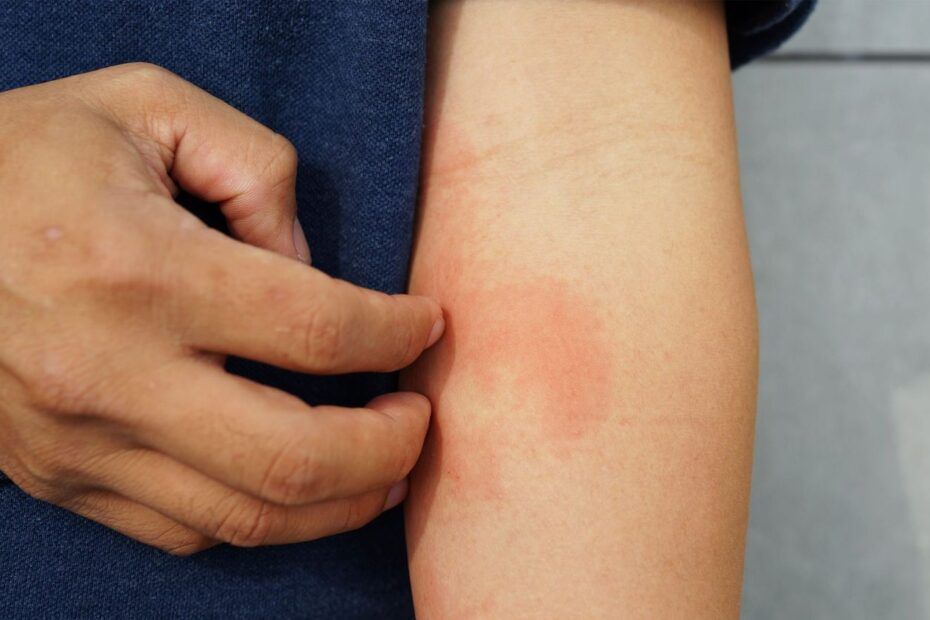 Erisipela este o infecție bacteriană a pielii