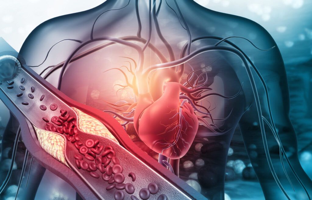 Metode simple de a reduce calcificarea coronariană