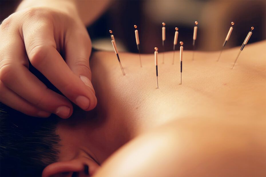 acupunctura