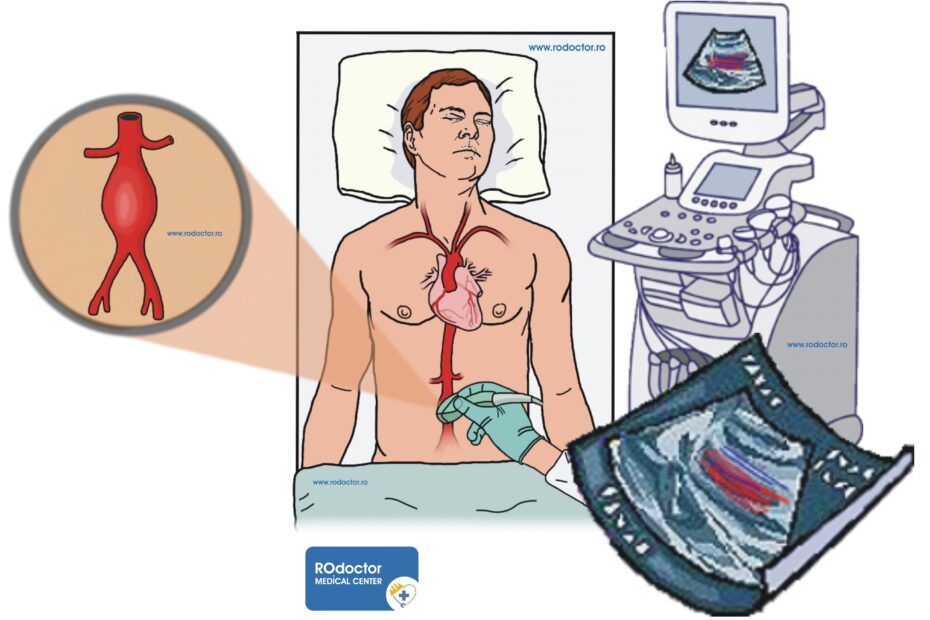 ecografie anevrism de aortă abdominală