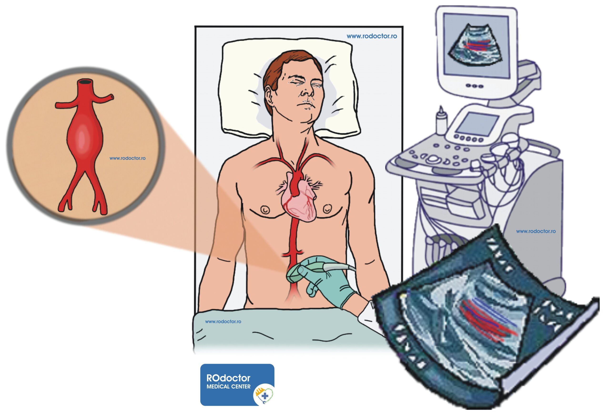 ecografie anevrism de aortă abdominală