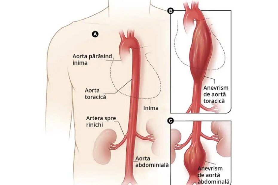 anevrism de aortă