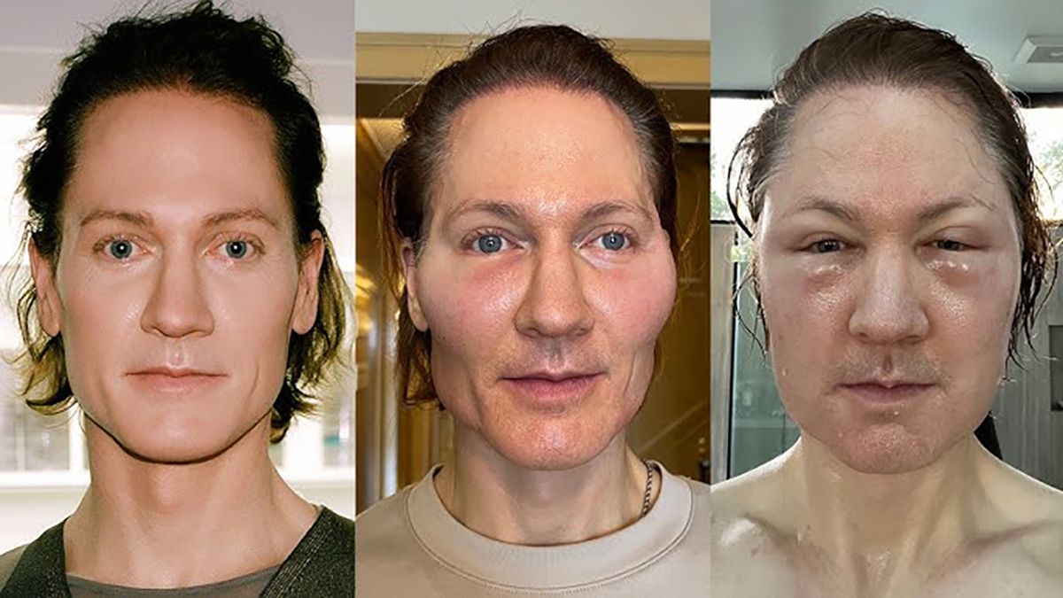 Milionarul care vrea să trăiască veșnic, desfigurat după o procedură controversată: „Nu mai puteam vedea”