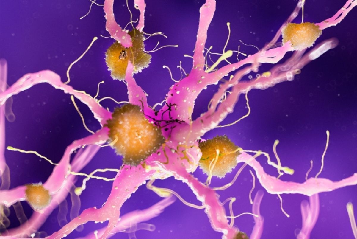 alzheimer
