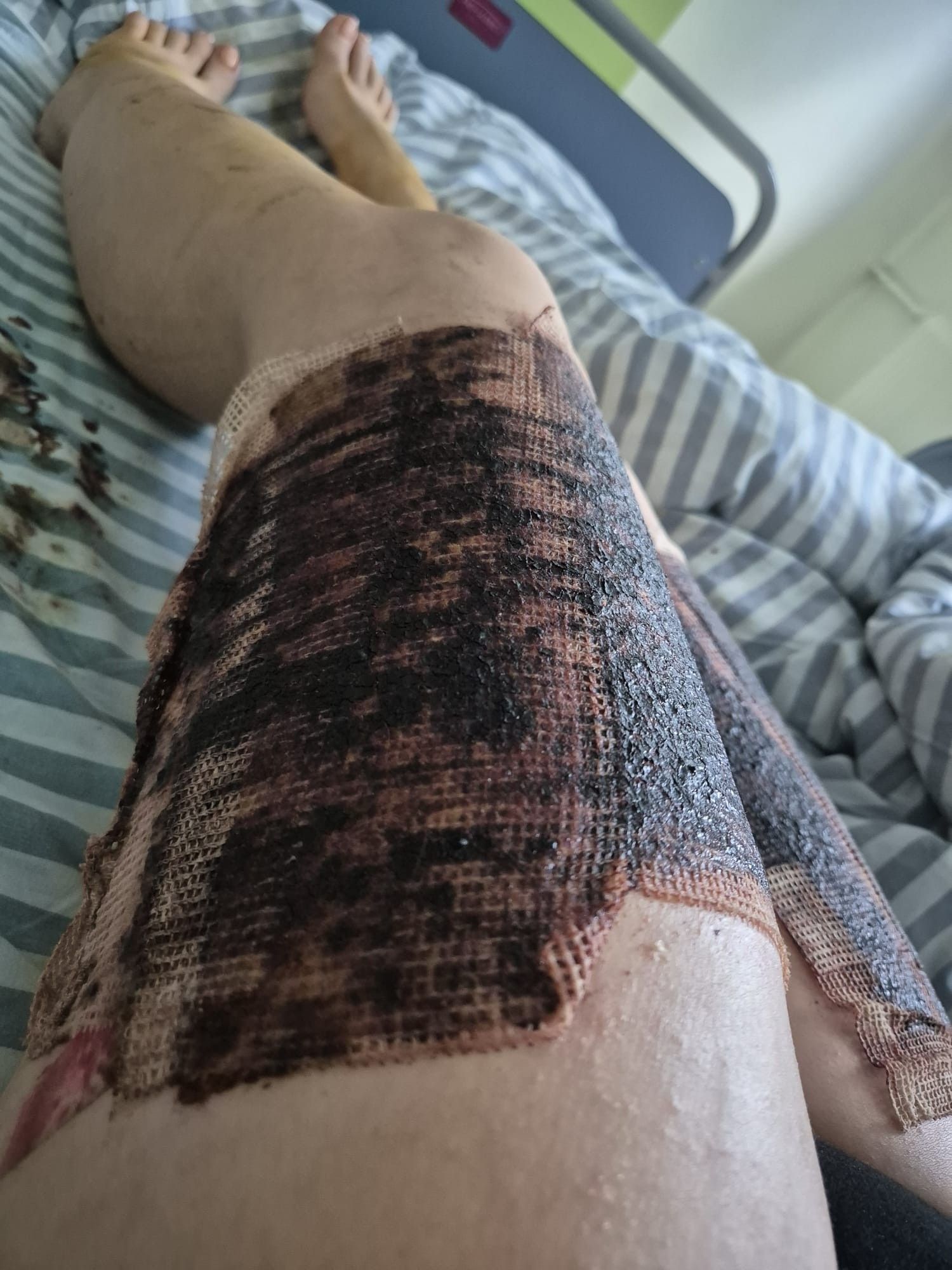 Gândaci și infecții nosocomiale la Centrul pentru Arși Floreasca. „Am țipat de durere, nu aveau calmante”