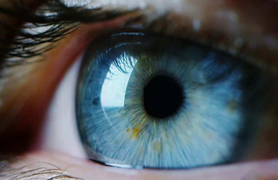 melanom ocular