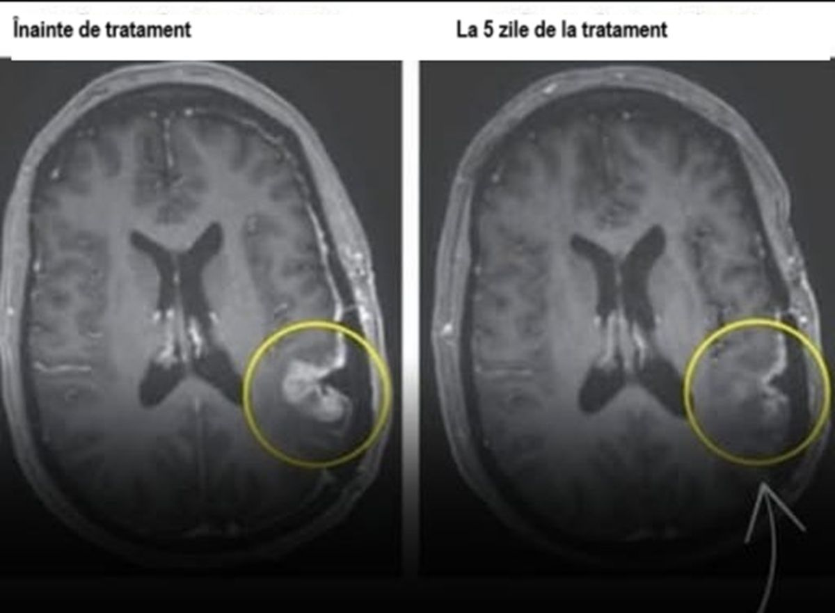 Un nou tratament pentru cancer a dus la dispariția tumorii în doar 5 zile