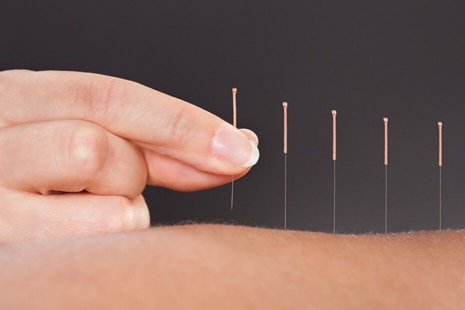 acupunctura