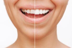 fatete dentare