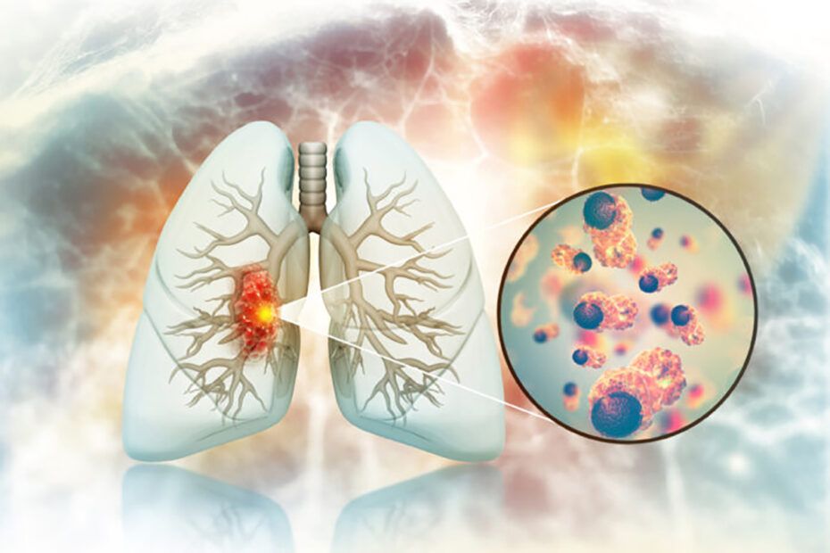 cancer pulmonar
