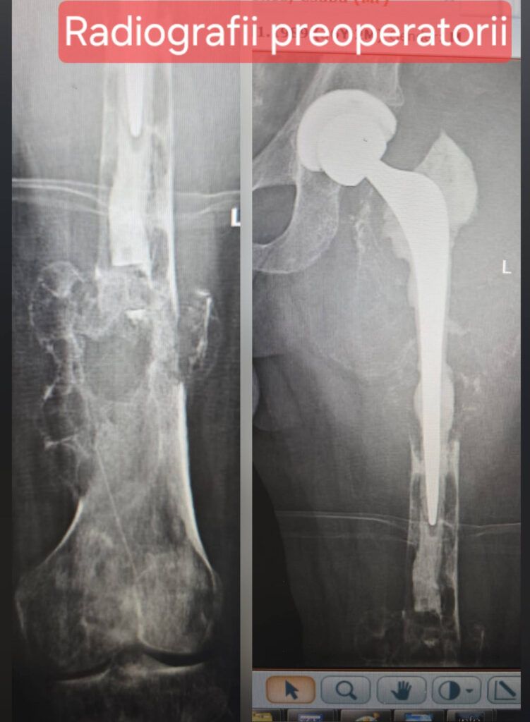 SUUB marchează o nouă performanță în chirurgia ortopedică oncologică