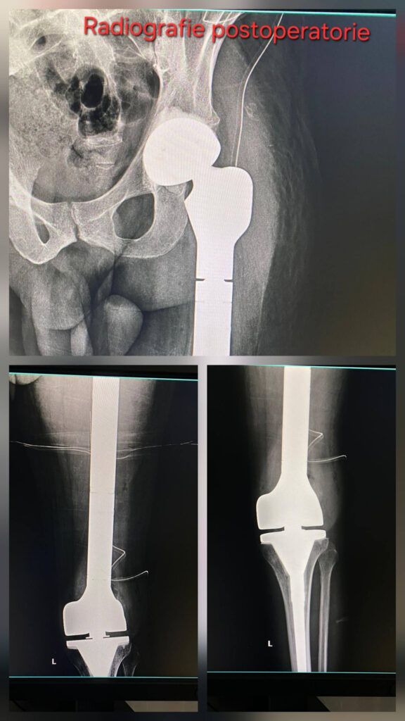 SUUB marchează o nouă performanță în chirurgia ortopedică oncologică