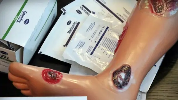 Ulcerul varicos se poate vindeca! Compresia si terapia locala hidroactiva