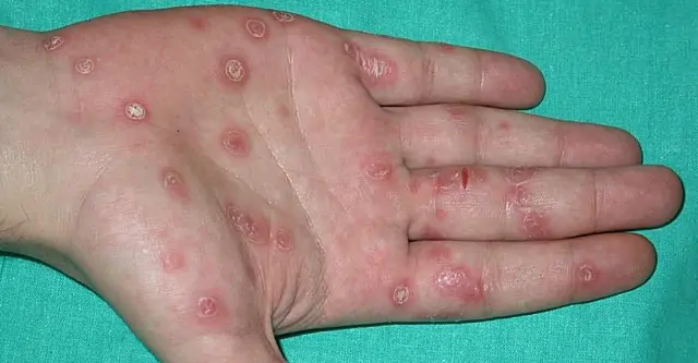 Sifilisul - cauze, simptome si tratament