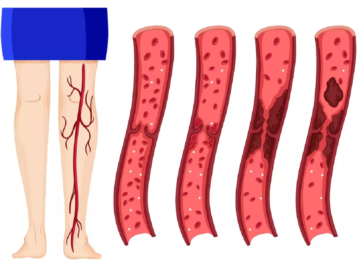 Chirurgie vasculara – Spitalul Sf. Constantin Brasov